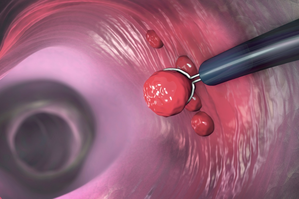 용종절제술 정의 이미지