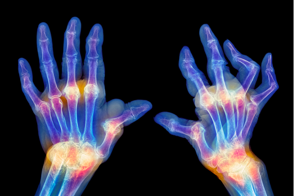 류마티스 관절염 정의 이미지