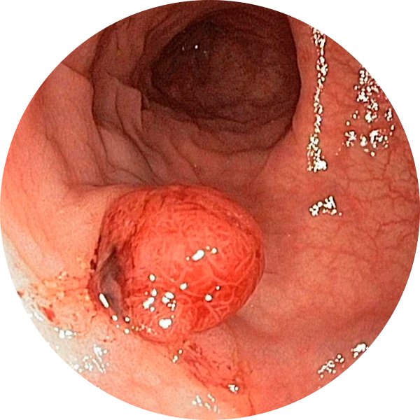 용종 발견 즉시 절제