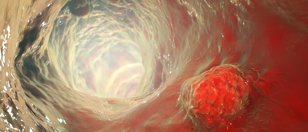 용종절제술 설명 이미지